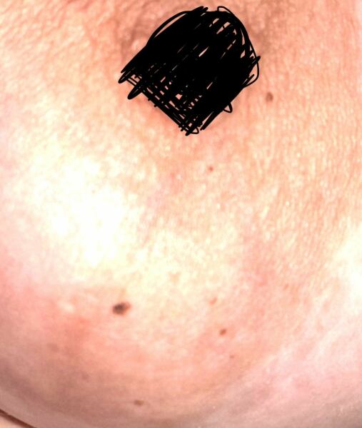 Spots on breast