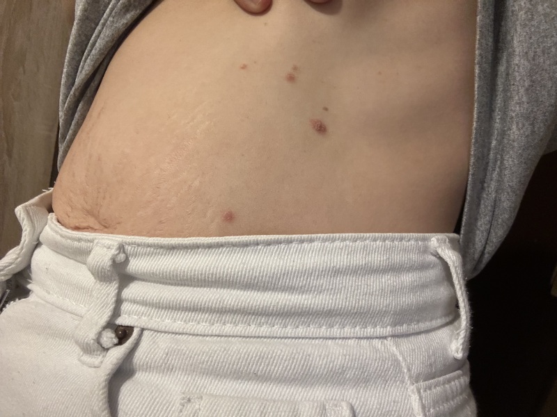 Rash