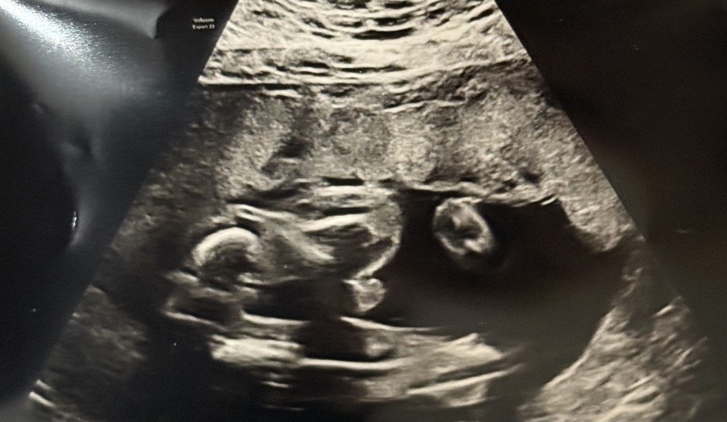 22 week potty shot gender