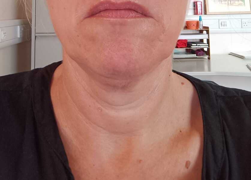 Could cosmetic tattooing help my chin issue?