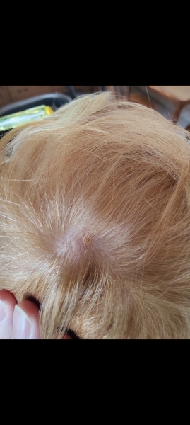 Spots on scalp