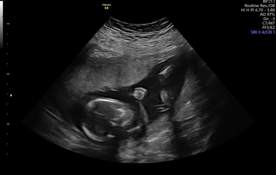3d scan at 17 weeks 🥹🤍