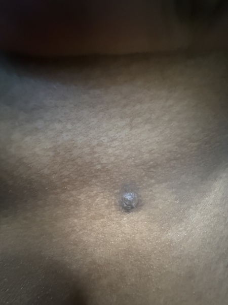 I’m so worried this is a skin cancer