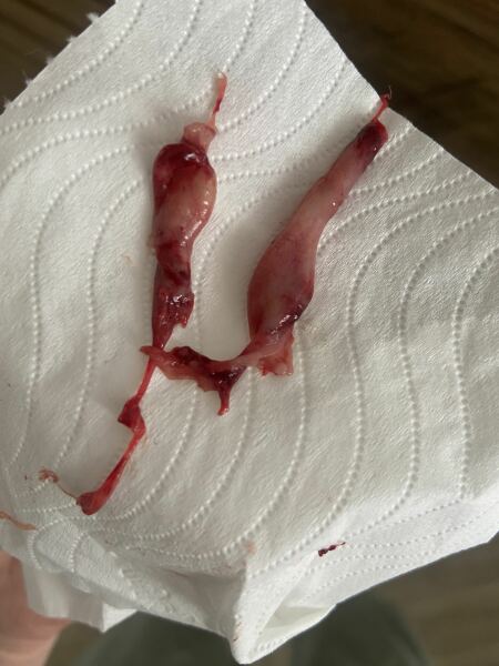 TMI graphic photo warning - what is this that came out of me?