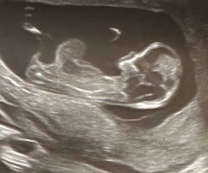 Abnormal 12 week scan