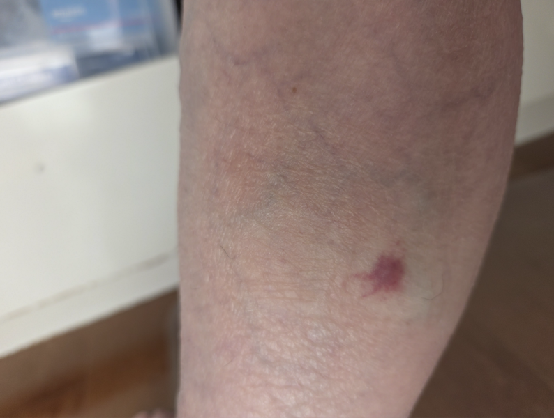Is this a bite or something else?