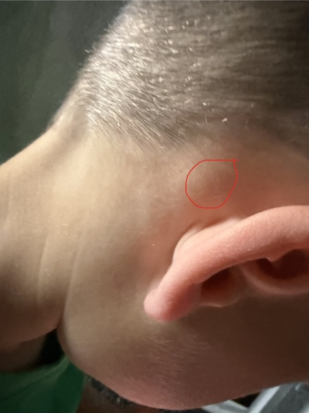 Bony lump behind sons ear