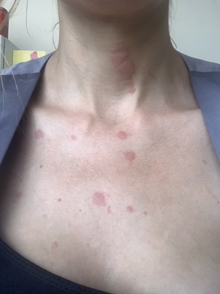 HELP! Burnt neck and chest with hot oil