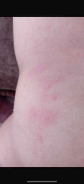 9 month old baby rash