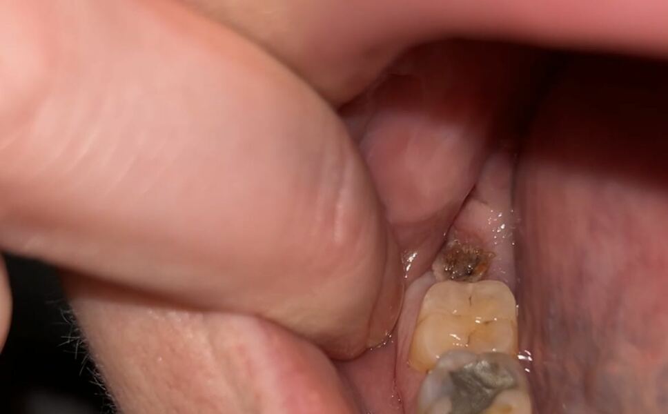 Is this dry socket?