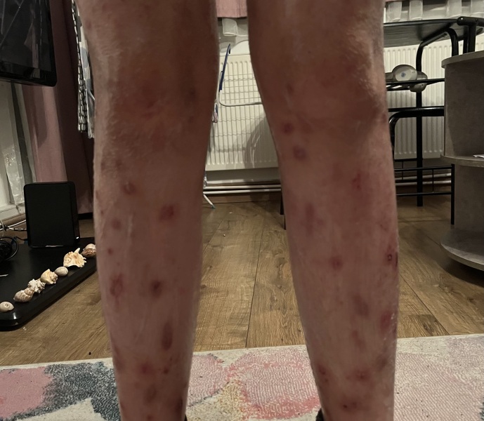 Horrible pic attached, eczema?