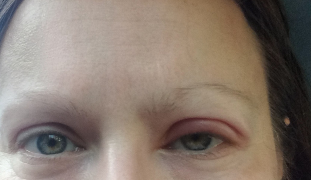 Would anyone go to A&E with this?