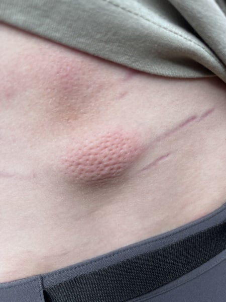 Strange lump on 15 year olds back
