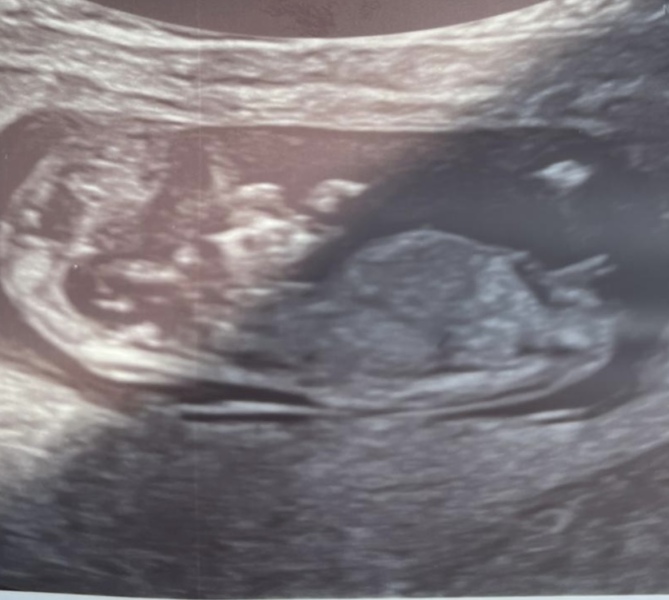 Nub Theory - boy or girl?