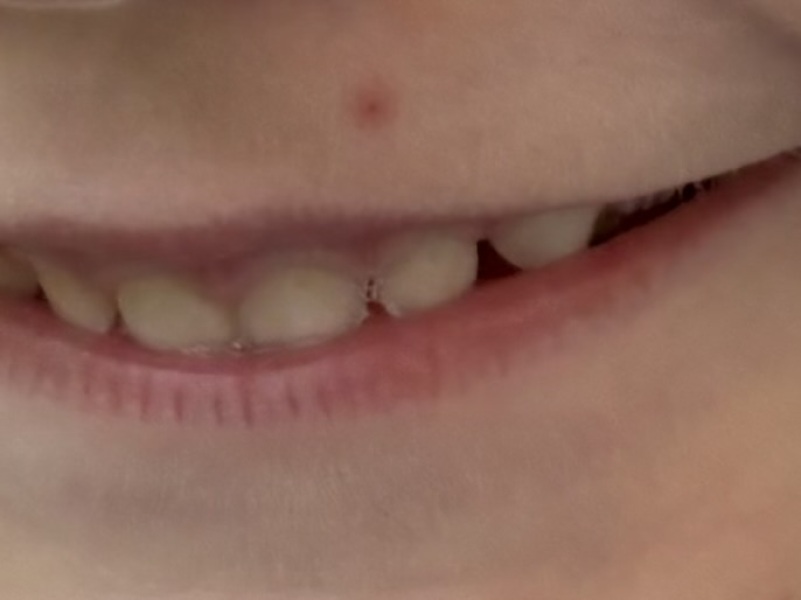 Red spot on toddlers skin