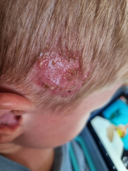 Fungal(?) infection that hasn't cleared in 8+ months