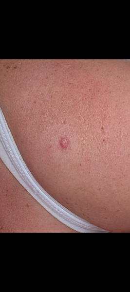 Back again regarding this mole