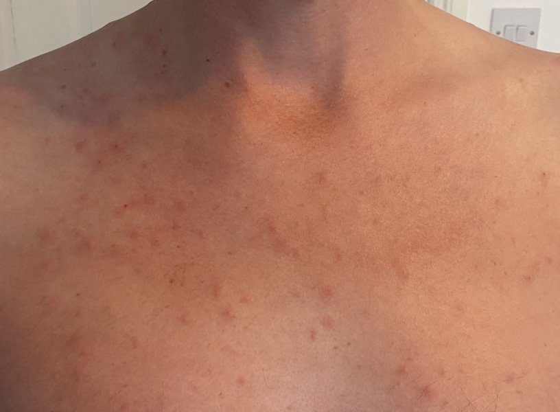 Rash