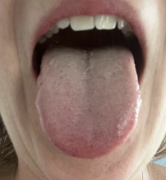 Is my tongue normal?