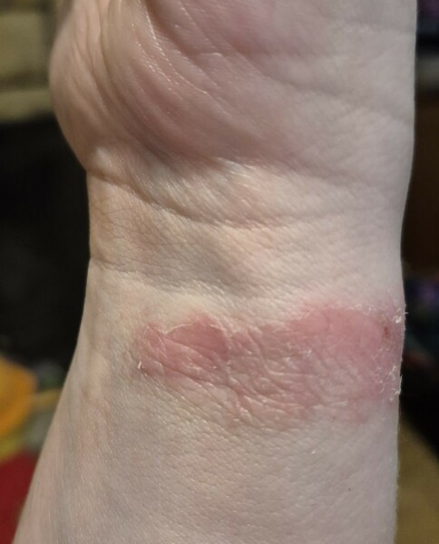 Withings Watch Strap hurts - any alternatives?