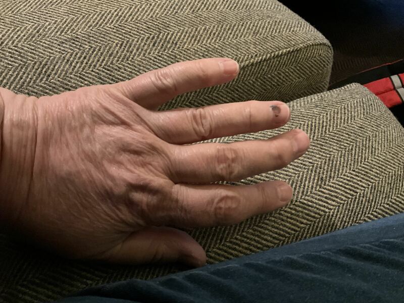 Bruise on nail from injury