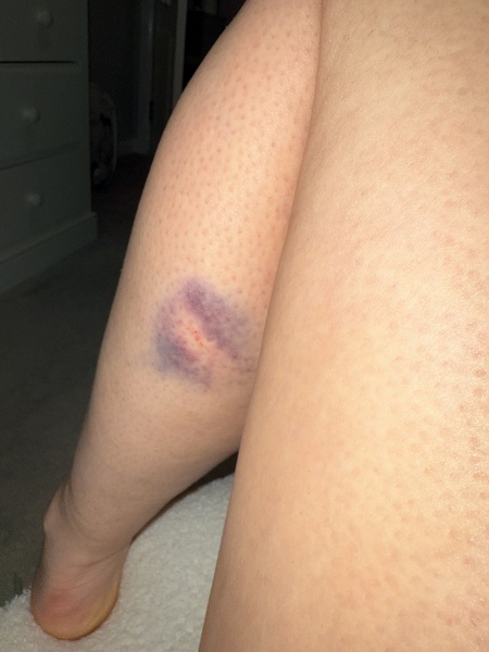 Does this look like an insect bite?