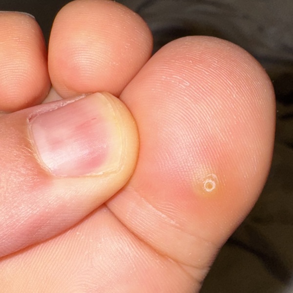 What is this on my child’s toe?