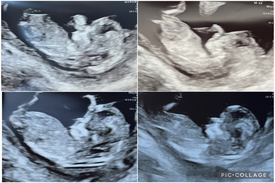 Boy or girl? 12 week scan