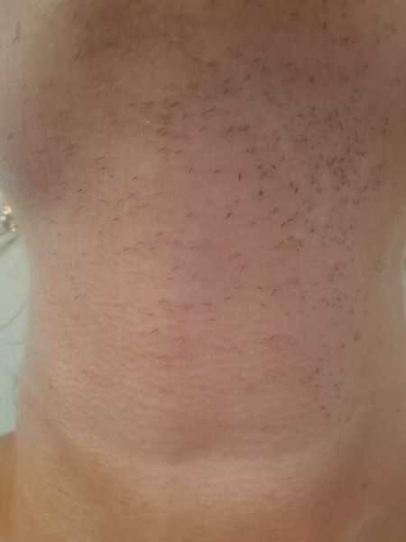 Hair removal due to pcos