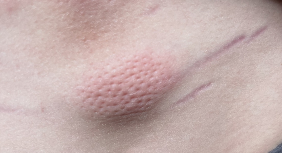 Strange lump on 15 year olds back