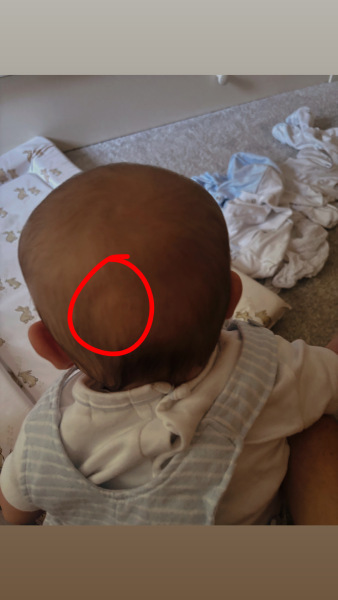 Four-month-old’s head