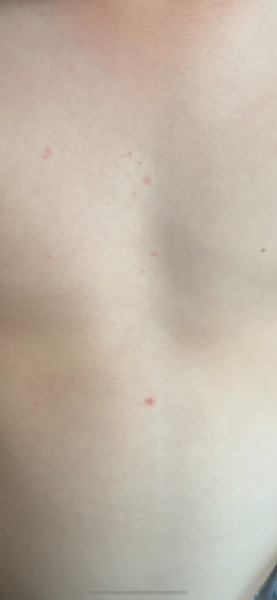 Is this chicken pox?