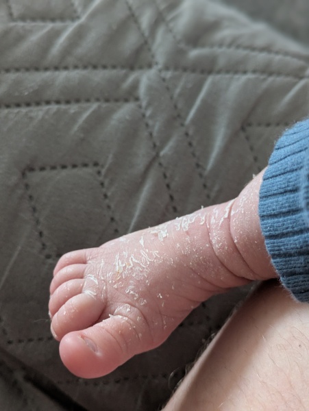 Newborn - white patches on skin