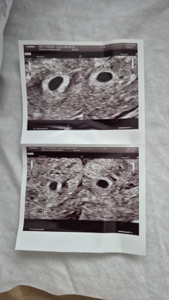 6 weeks pregnant twins and symtoms vanished