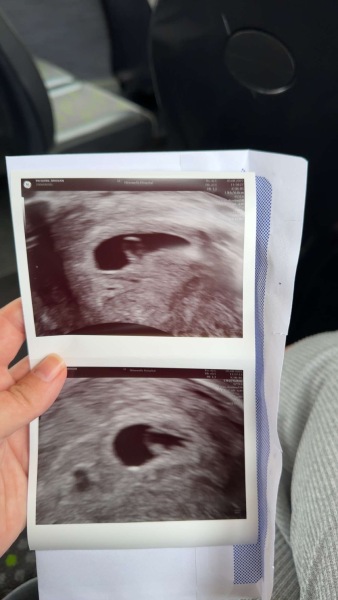 Pregnancy pains