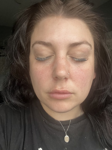Butterfly rash?