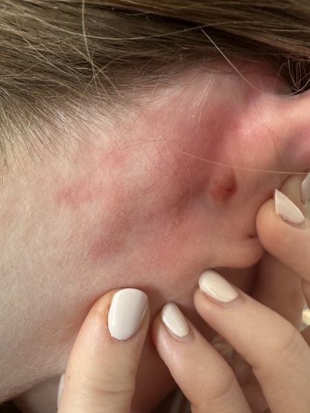 Freaking out… Can anyone tell me what this lump is behind my ear!?