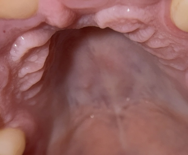 Any dentists about or GPs? Small hard lump roof of mouth