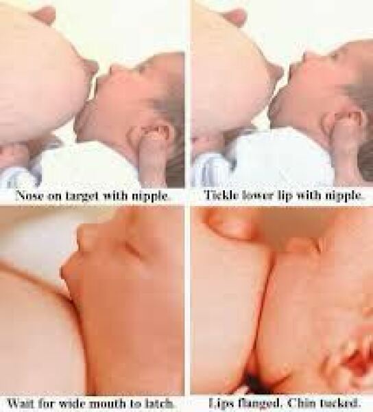 Breastfeeding with implants