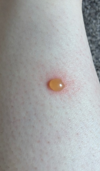 Insect bite (with photo!)