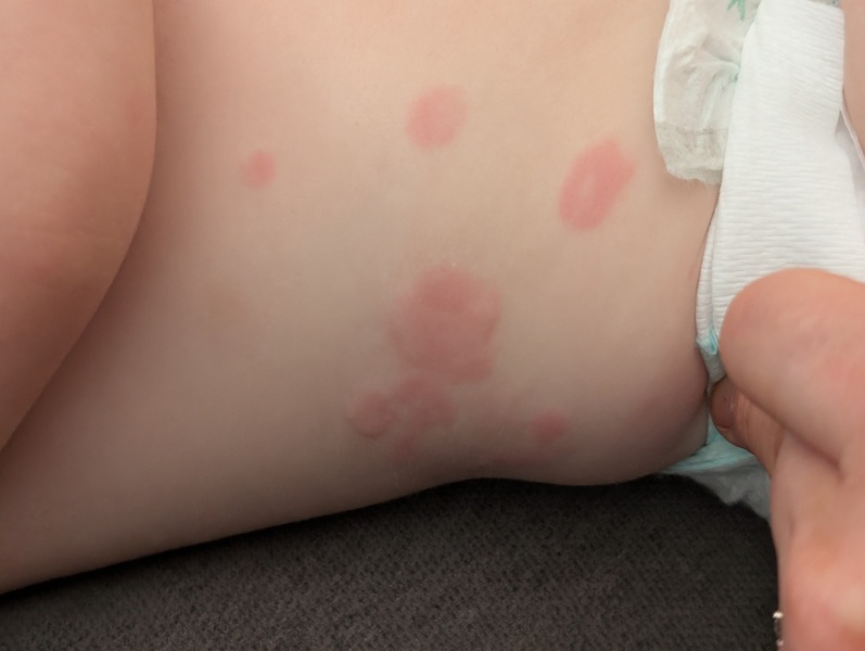 Hives ??? Advice please