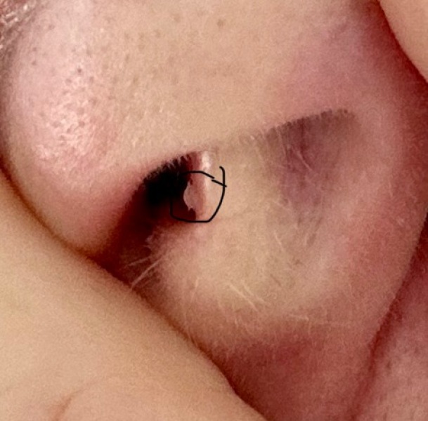 Worried about growth inside nostril - warning photo attached