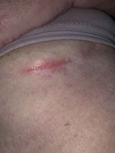 Rash under breast