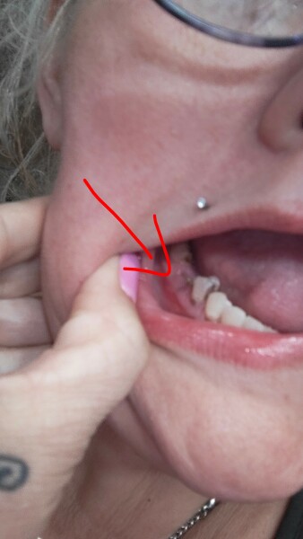 Tooth extraction after care advice!