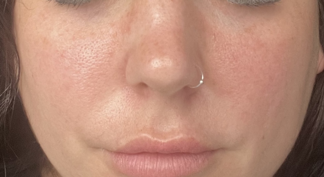 Butterfly rash?