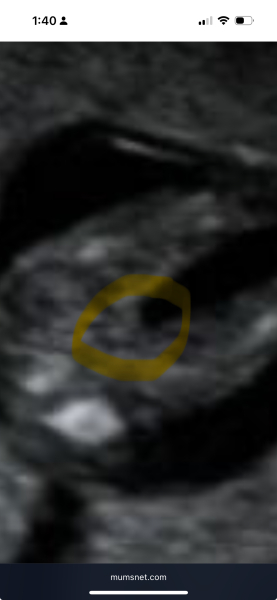 To think the sonographer could be wrong?