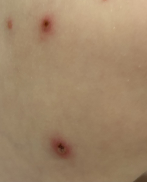 To ask if this looks normal? Chicken pox and scabbing