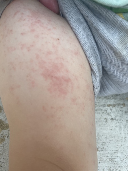 Rash on toddler - opinions greatly appreciated as very worried