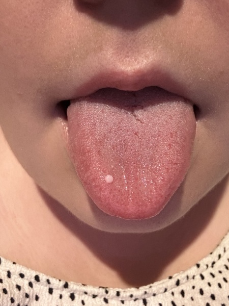 Painless lump on tongue