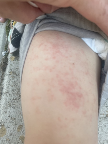 Rash on toddler - opinions greatly appreciated as very worried
